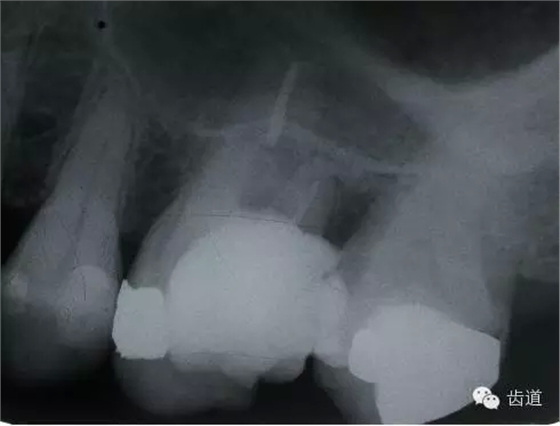 根管治療的并發(fā)癥及處理 根管治療的并發(fā)癥及處理