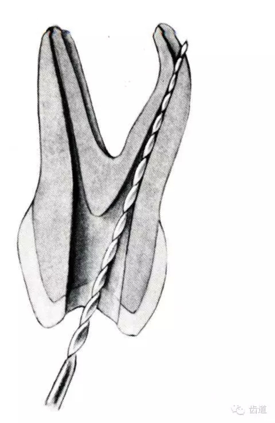 根管治療的并發(fā)癥及處理 根管治療的并發(fā)癥及處理