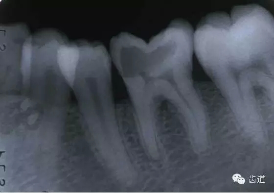 根管治療的并發(fā)癥及處理 根管治療的并發(fā)癥及處理