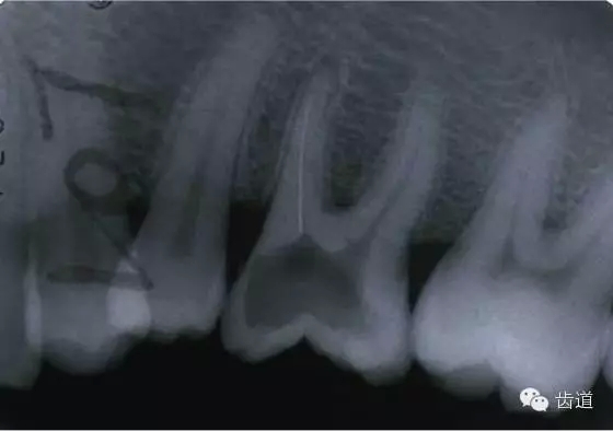 根管治療的并發(fā)癥及處理 根管治療的并發(fā)癥及處理
