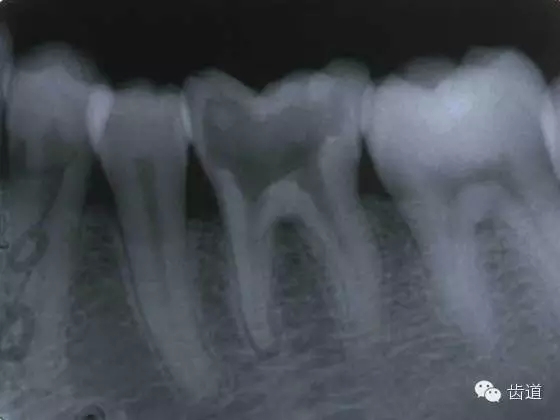 根管治療的并發(fā)癥及處理 根管治療的并發(fā)癥及處理