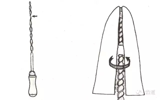 根管治療的并發(fā)癥及處理 根管治療的并發(fā)癥及處理