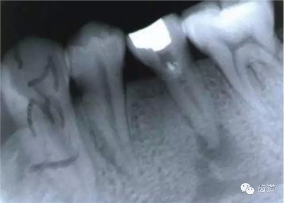 根管治療的并發(fā)癥及處理 根管治療的并發(fā)癥及處理