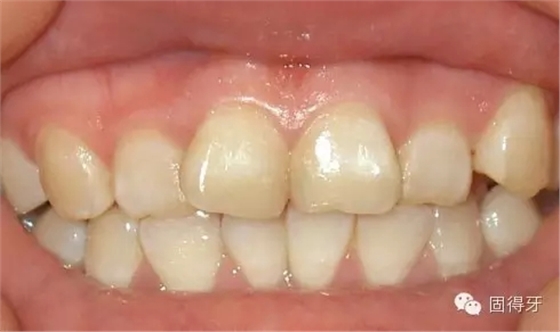 只知道蟲(chóng)牙？快來(lái)看看那些你見(jiàn)都沒(méi)見(jiàn)過(guò)的牙病！ 