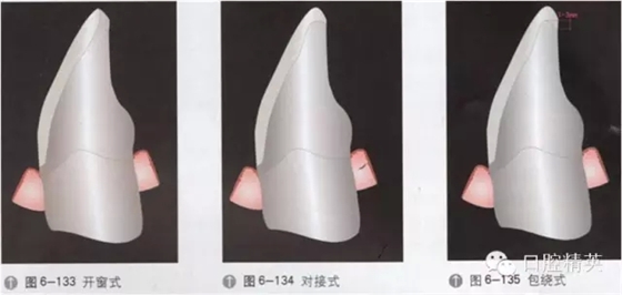 超薄瓷貼面介紹與臨床操作步驟