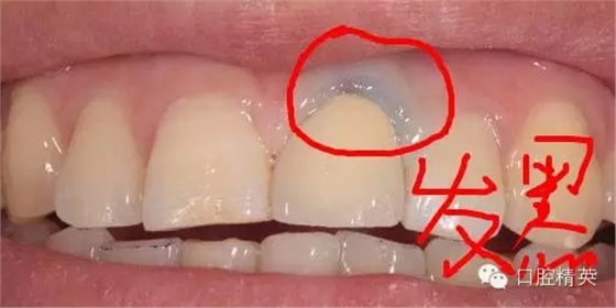 為什么牙醫(yī)叫您做二氧化鋯 為什么牙醫(yī)叫您做二氧化鋯