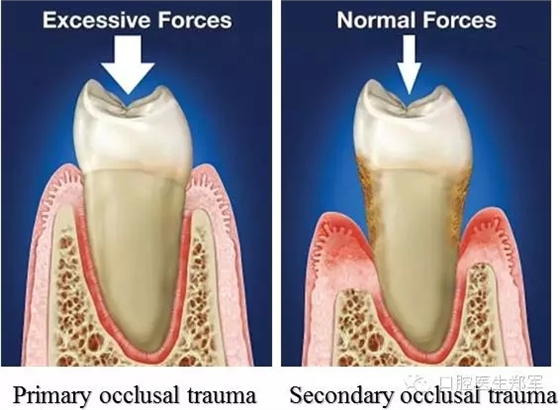 牙周炎的相關(guān)修復(fù)治療原則 牙周炎的相關(guān)修復(fù)治療原則