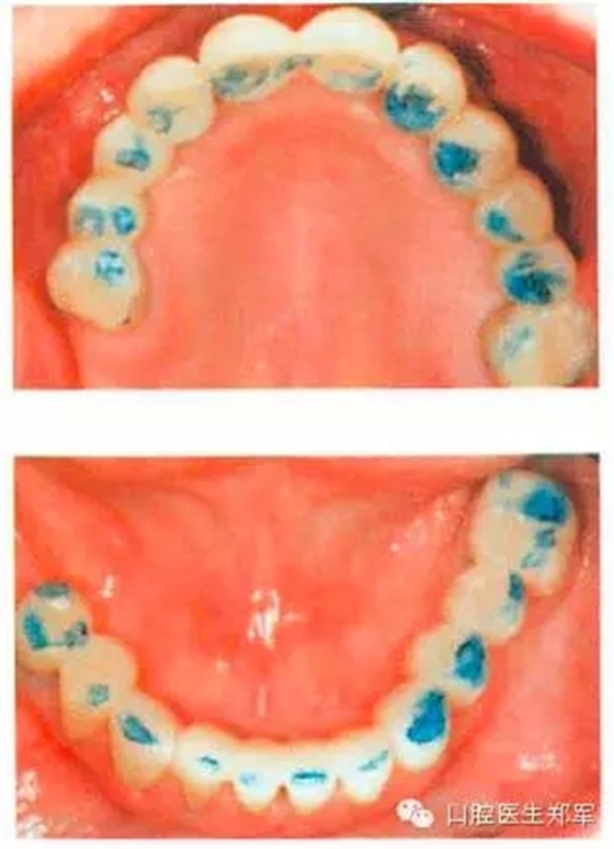 牙周炎的相關(guān)修復(fù)治療原則 牙周炎的相關(guān)修復(fù)治療原則
