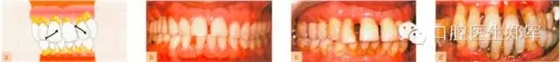 牙周炎的相關(guān)修復(fù)治療原則 牙周炎的相關(guān)修復(fù)治療原則