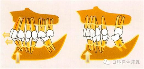 牙周炎的相關(guān)修復(fù)治療原則 牙周炎的相關(guān)修復(fù)治療原則