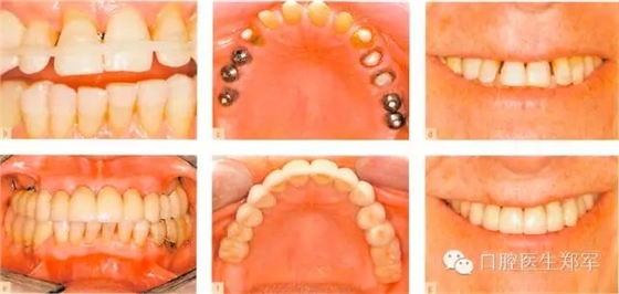 牙周炎的相關(guān)修復(fù)治療原則 牙周炎的相關(guān)修復(fù)治療原則