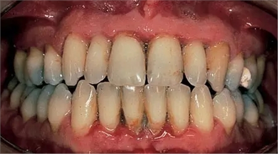 這十種常見口腔疾病，你有遇到過么？