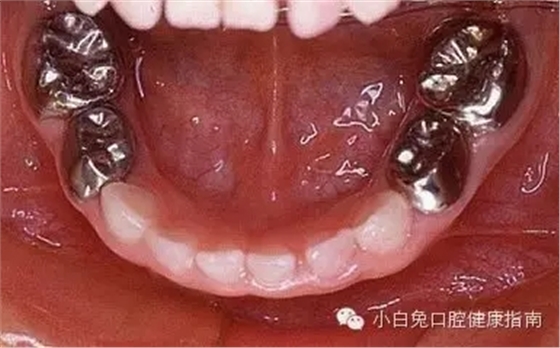 乳牙預(yù)成冠：小朋友專屬的&ldquo;乳牙保護(hù)套&rdquo;