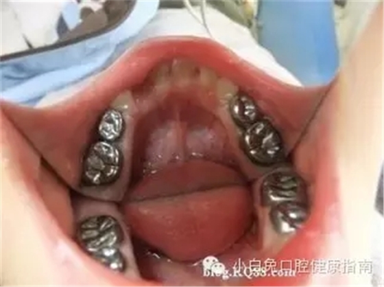 乳牙預(yù)成冠：小朋友專屬的&ldquo;乳牙保護(hù)套&rdquo;