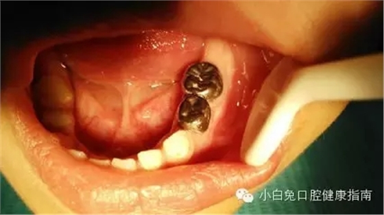 乳牙預(yù)成冠：小朋友專屬的&ldquo;乳牙保護(hù)套&rdquo;