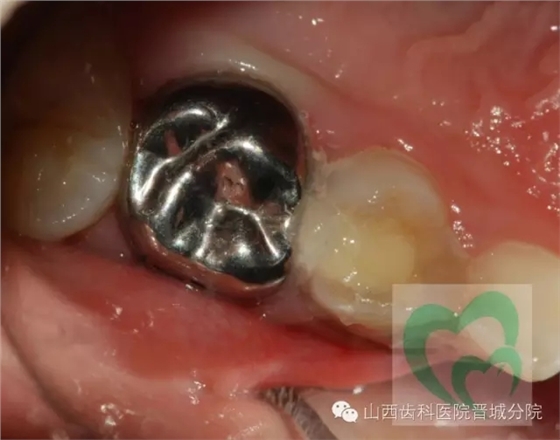 乳牙預(yù)成冠&mdash;&mdash;大面積乳牙齲壞的首選辦法