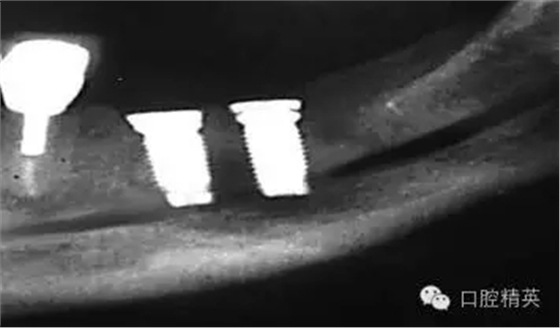 口腔種植各種失敗模式的病因探查 口腔種植各種失敗模式的病因探查