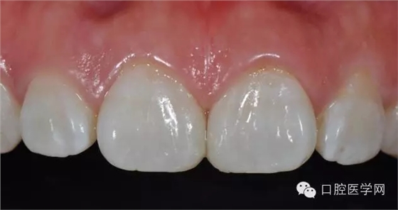 6樹脂關(guān)閉前牙間隙