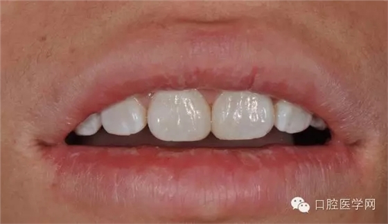 樹脂關(guān)閉前牙間隙