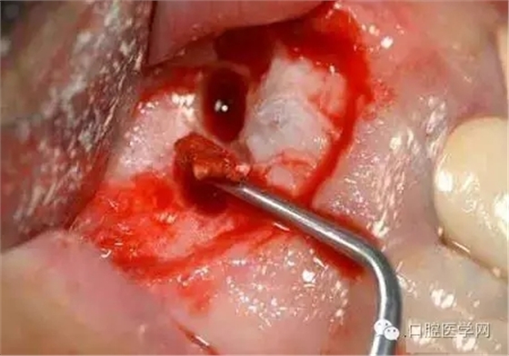 根尖切除術(shù)操作全過程