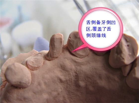 口腔修復醫(yī)生備牙取摸常見問題系列之——基牙倒凹 與 備牙時“就位道”的處理 口腔修復醫(yī)生備牙取摸常見問題系列之——基牙倒凹 與 備牙時“就位道”的處理