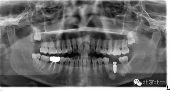 種植遇到骨島怎么辦