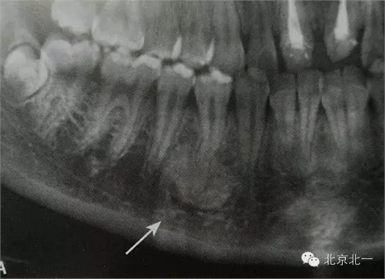 種植遇到骨島怎么辦