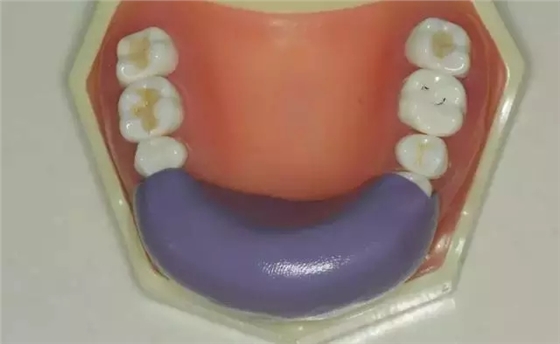 硅橡膠導(dǎo)板&mdash;&mdash;牙體預(yù)備步驟詳解