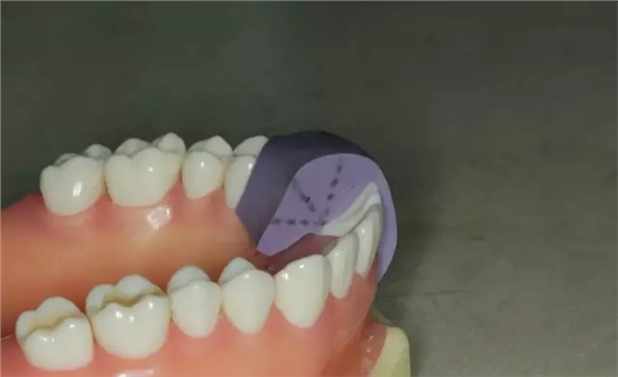 硅橡膠導(dǎo)板&mdash;&mdash;牙體預(yù)備步驟詳解