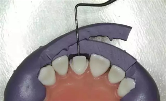 硅橡膠導(dǎo)板&mdash;&mdash;牙體預(yù)備步驟詳解