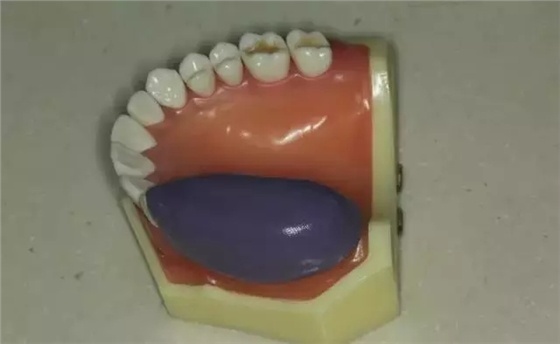 硅橡膠導(dǎo)板&mdash;&mdash;牙體預(yù)備步驟詳解