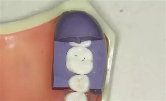 硅橡膠導(dǎo)板&mdash;&mdash;牙體預(yù)備步驟詳解