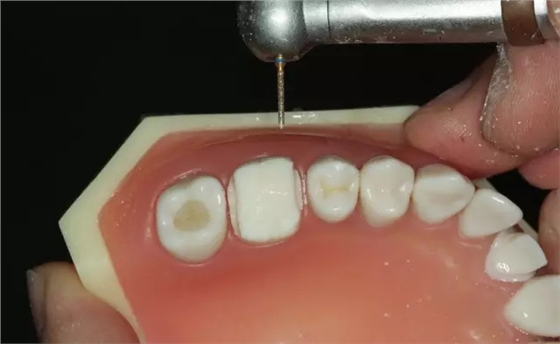 硅橡膠導(dǎo)板&mdash;&mdash;牙體預(yù)備步驟詳解