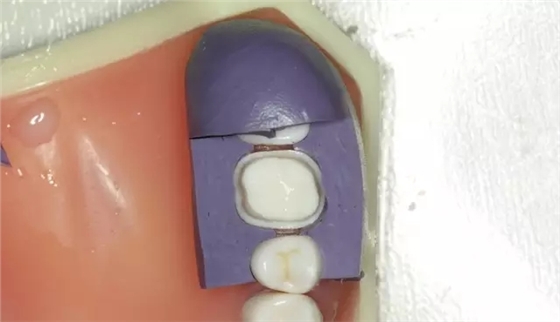 硅橡膠導(dǎo)板&mdash;&mdash;牙體預(yù)備步驟詳解