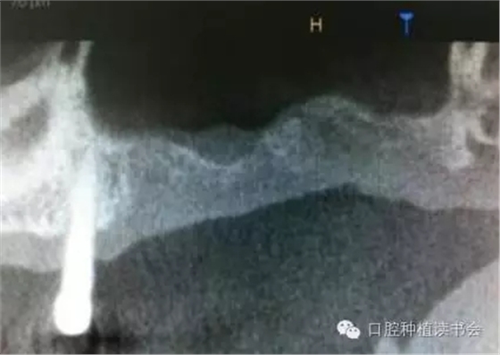 上頜后牙區(qū)種植治療的關(guān)鍵技術(shù)之&mdash;上頜竇提升術(shù)