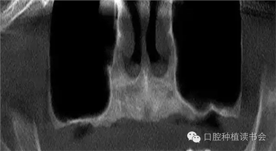 上頜后牙區(qū)種植治療的關(guān)鍵技術(shù)之&mdash;上頜竇提升術(shù)