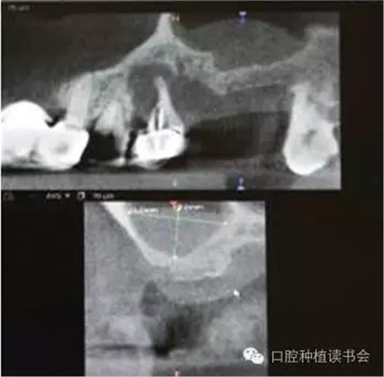 上頜后牙區(qū)種植治療的關(guān)鍵技術(shù)之&mdash;上頜竇提升術(shù)