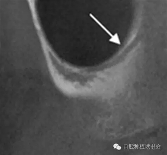 上頜后牙區(qū)種植治療的關(guān)鍵技術(shù)之&mdash;上頜竇提升術(shù)