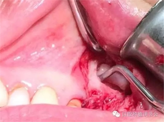 上頜后牙區(qū)種植治療的關(guān)鍵技術(shù)之&mdash;上頜竇提升術(shù)