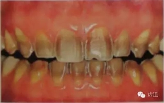 瓷貼面的粘接步驟及技術要點 瓷貼面的粘接步驟及技術要點