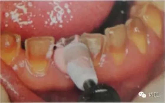 瓷貼面的粘接步驟及技術要點 瓷貼面的粘接步驟及技術要點