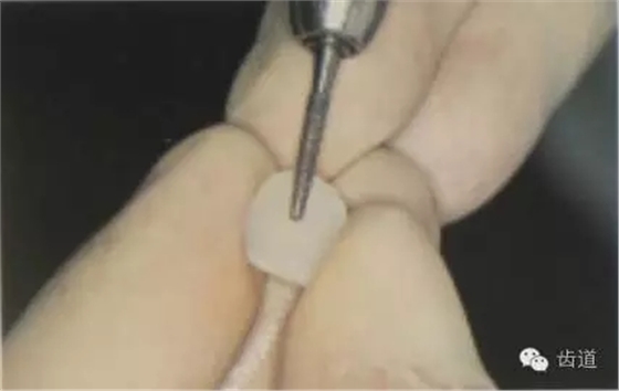 瓷貼面的粘接步驟及技術要點 瓷貼面的粘接步驟及技術要點