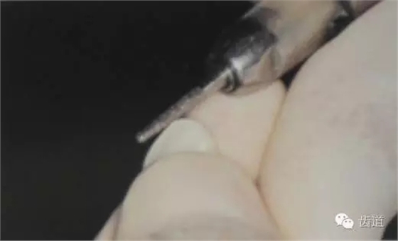 瓷貼面的粘接步驟及技術要點 瓷貼面的粘接步驟及技術要點