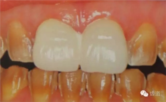 瓷貼面的粘接步驟及技術要點 瓷貼面的粘接步驟及技術要點