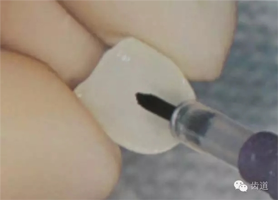 瓷貼面的粘接步驟及技術要點 瓷貼面的粘接步驟及技術要點