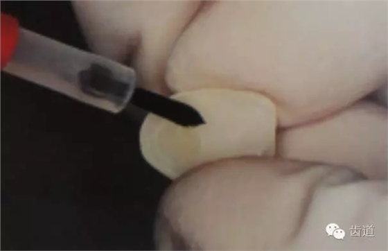 瓷貼面的粘接步驟及技術要點 瓷貼面的粘接步驟及技術要點