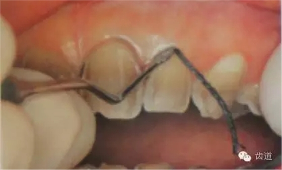 瓷貼面的粘接步驟及技術要點 瓷貼面的粘接步驟及技術要點