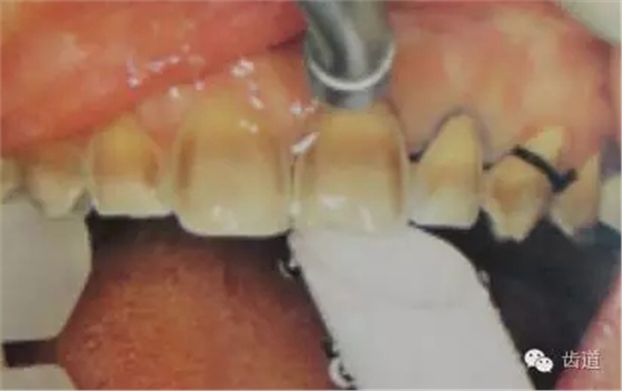 瓷貼面的粘接步驟及技術要點 瓷貼面的粘接步驟及技術要點