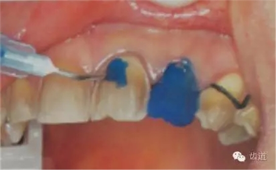 瓷貼面的粘接步驟及技術要點 瓷貼面的粘接步驟及技術要點