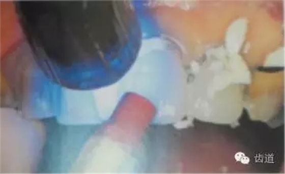 瓷貼面的粘接步驟及技術要點 瓷貼面的粘接步驟及技術要點